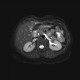 Metastasis in duodenal wall: MRI - Magnetic Resonance Imaging